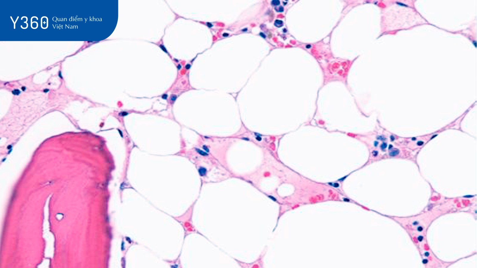 Ca lâm sàng điều trị suy tủy xương vô căn với Antithymocyte Globulin thỏ image