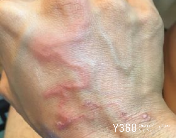 ẤU TRÙNG DI CHUYỂN Ở DA image