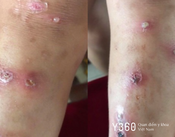 BỆNH DA DO NHIỄM VI KHUẨN image