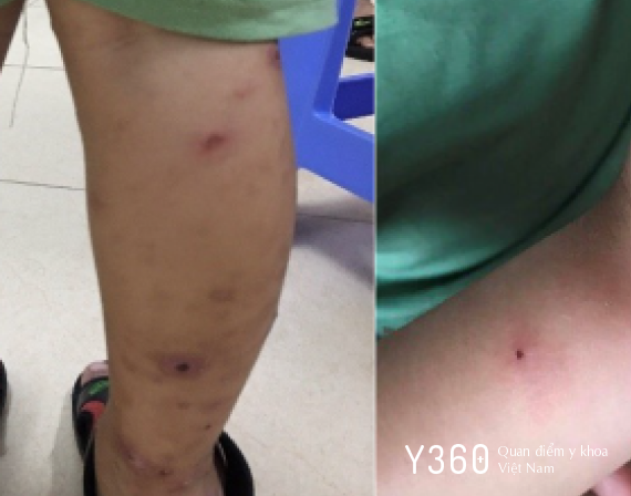 BỆNH DA DO NHIỄM VI KHUẨN image