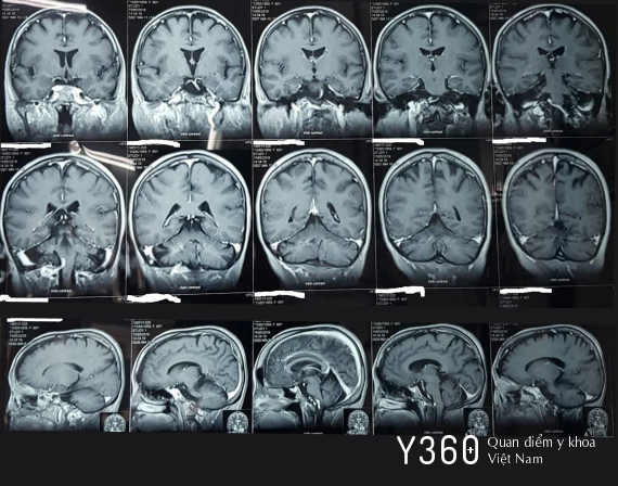 HỘI CHỨNG TIỂU NÃO image