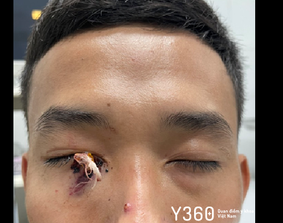 DỊ VẬT ĐÂM VÀO MẮT image