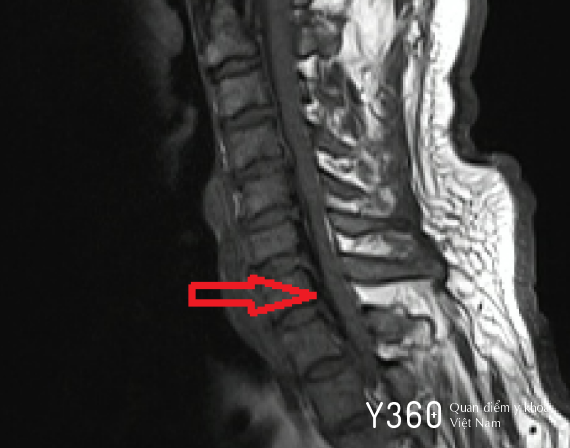 BỆNH LÝ TỦY SỐNG image