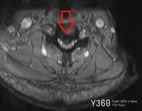 BỆNH LÝ TỦY SỐNG image
