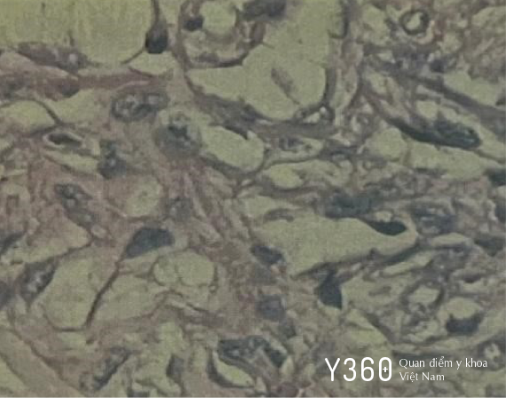 TIỂU MÁU ĐỎ TƯƠI image