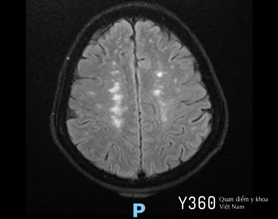 NHỒI MÁU NÃO image