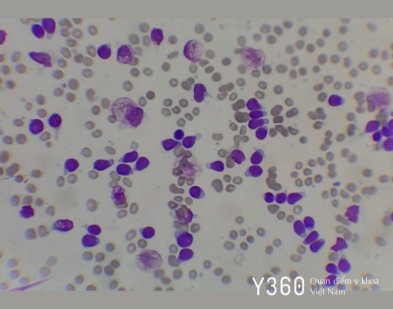 BẠCH CẦU CẤP DÒNG LYMPHO T image