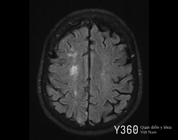 HẸP ĐỘNG MẠCH CẢNH image