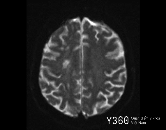 HẸP ĐỘNG MẠCH CẢNH image