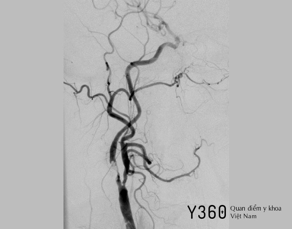 HẸP ĐỘNG MẠCH CẢNH image