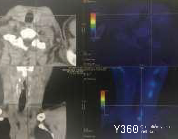 UNG THƯ GIÁP DẠNG TỦY image