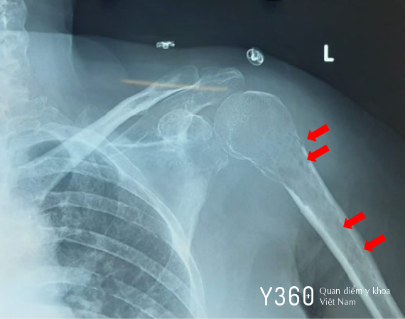 ĐAU NHỨC XƯƠNG ÂM Ỉ image