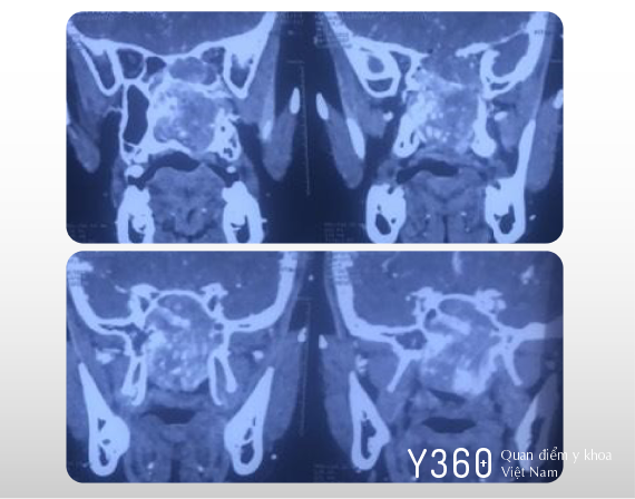 U XƠ VÒM image