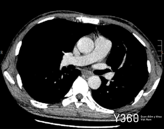 COVID-19 MỨC ĐỘ NẶNG image
