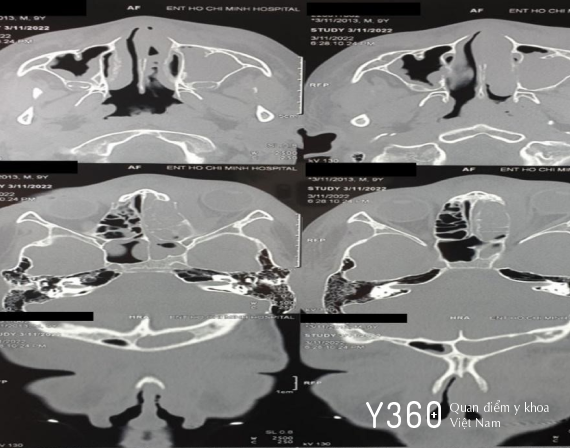 VIÊM XOANG BIẾN CHỨNG Ổ MẮT image