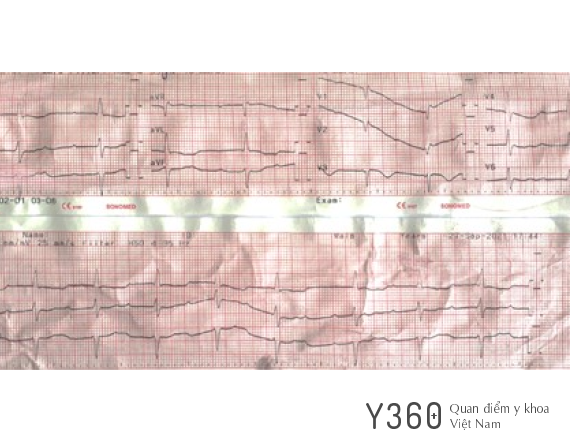 VIÊM CƠ TIM CẤP image