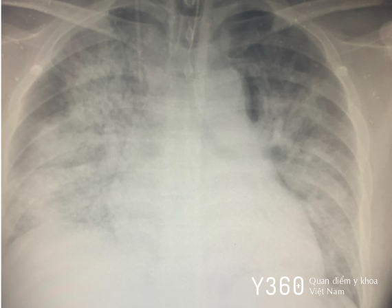 SỐC NHIỄM KHUẨN image