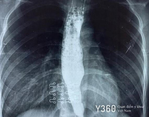 CO THẮT TÂM VỊ image