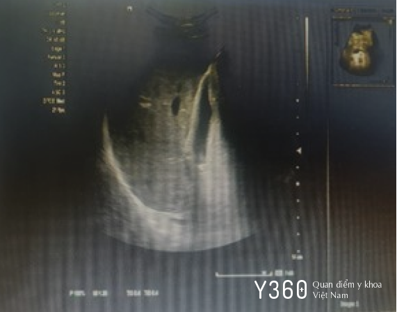 VIÊM TỤY CẤP DO SỎI MẬT image