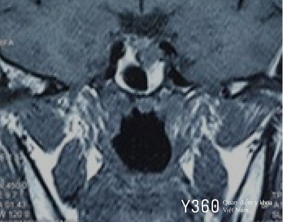 TRIỆU CHỨNG NHIỄM ĐỘC GIÁP image