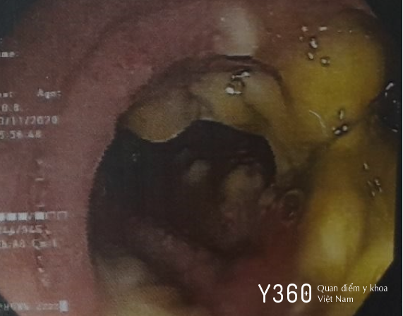 VIÊM ĐẠI TRÀNG GIẢ MẠC image